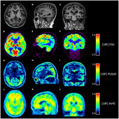 Case Report: [18F]PI2620 as a Tau Imaging Agent in Posterior Cortical Atrophy